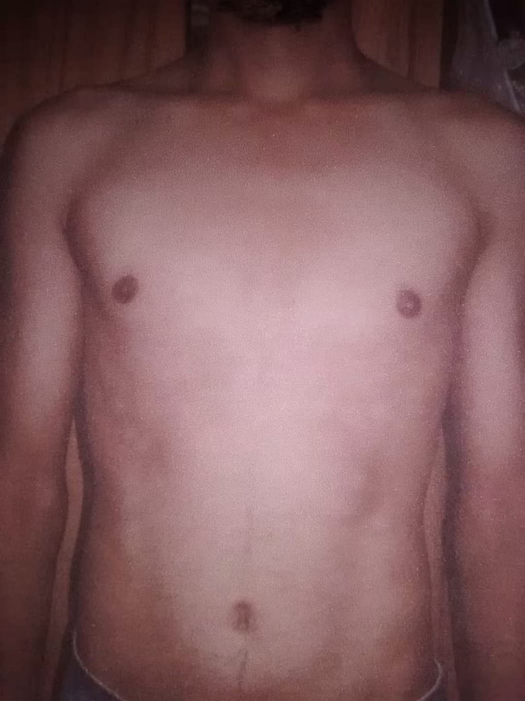 Psoriasis, later photograph