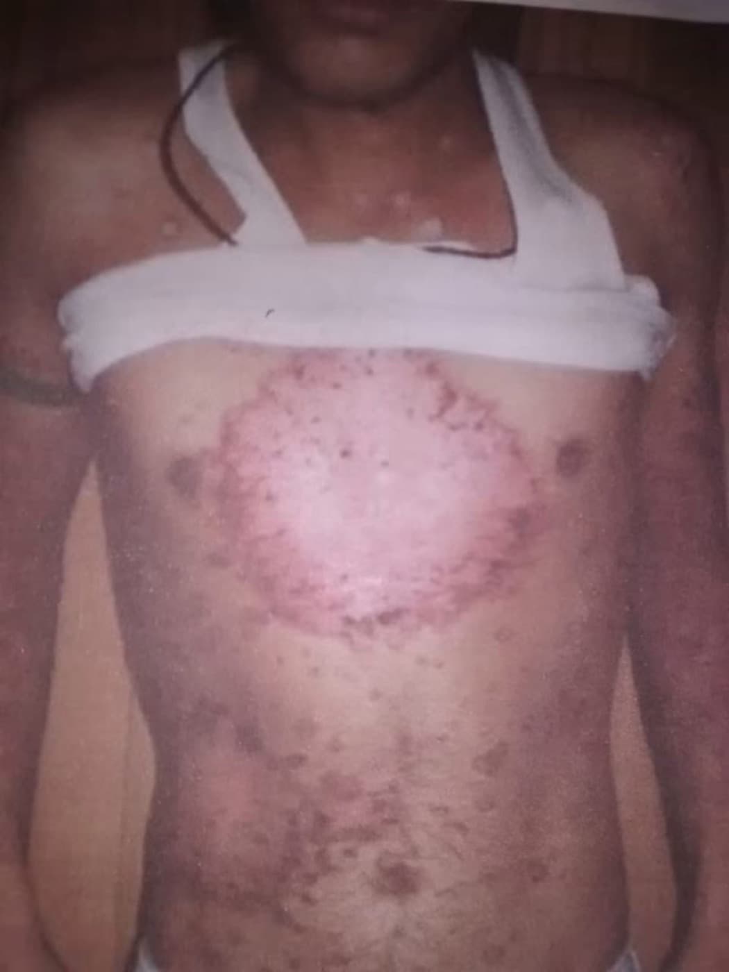 Psoriasis, earlier photograph